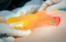 Cấp cứu bệnh nhân vỡ u buồng trứng, bụng chứa hơn 15 lít dịch