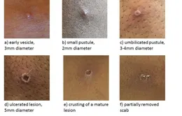 Bình đẳng y tế nhìn từ bệnh đậu mùa khỉ