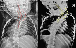 Bé trai 6 tuổi bị biến dạng vẹo lệch cột sống - lời cảnh báo cho các bậc cha mẹ