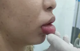 Môi sưng phồng, căng cứng, đau nhức sau tiêm filler