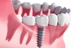 Trước khi thực hiện Implant cần lưu ý những vấn đề gì?