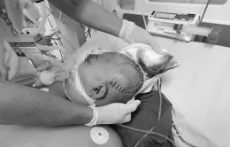 Gắp viên đạn cho bé trai bị súng bắn vào đầu