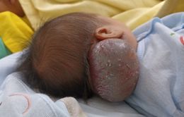 Cắt khối u máu khổng lồ, hiếm gặp cho bé sơ sinh