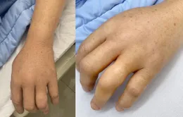 Truyền 6 lọ huyết thanh kịp thời cứu bệnh nhân bị rắn độc cắn