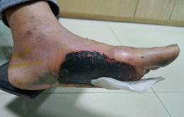 Cảnh báo: Hoại tử, loét bàn chân do sử dụng túi chườm nóng ở bệnh nhân đái tháo đường