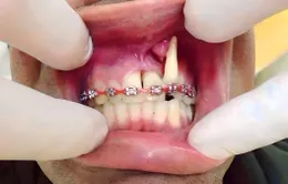 Tỉ lệ biến chứng niềng răng tăng cao, nguyên nhân do đâu?