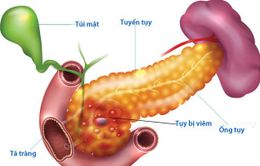 Nguy hiểm bệnh viêm tụy cấp