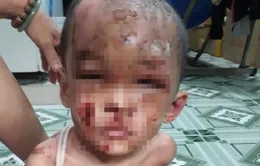 Bé trai 1 tuổi người đầy vết thương, vết bỏng, nghi bị cha mẹ bạo hành