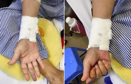 Suýt phải cắt cụt bàn tay do tắc động mạch