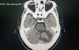 Đột ngột đau đầu, mất cân bằng, đi viện phát hiện khối u não