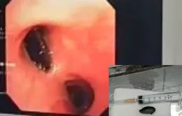 Nhập viện vì khó thở, đau tức ngực, bác sĩ phát hiện "thủ phạm" là hạt hồng xiêm nằm chắn ngang lòng phế quản