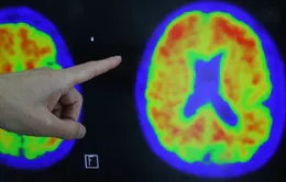 Mỹ xây dựng cơ sở dữ liệu trị giá 300 triệu USD thúc đẩy nghiên cứu về bệnh Alzheimer
