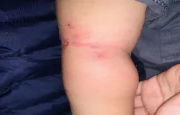 Nguy hiểm từ nhiễm trùng da do tụ cầu
