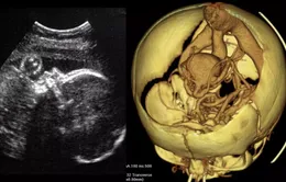 Ca phẫu thuật não đầu tiên trên thai nhi trong bụng mẹ được thực hiện