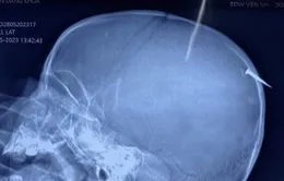 Phẫu thuật kịp thời cho bé trai bị cây đinh dài 3cm đâm qua xương sọ