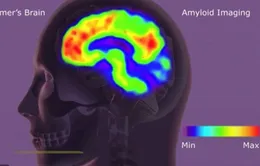 Thuốc Donanemab làm chậm sự tiến triển của bệnh Alzheimer