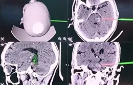 Phẫu thuật khối u mạch máu vùng thân não có biến chứng xuất huyết