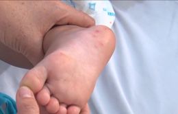 Tăng số trẻ mắc tay chân miệng ở ĐBSCL