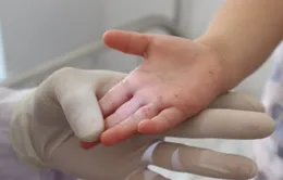 TP. Hồ Chí Minh chỉ đạo tăng cường phòng chống bệnh tay chân miệng