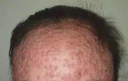 Eczema và nhiều nguy cơ tiềm ẩn