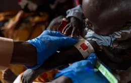 Dịch sởi và tình trạng suy dinh dưỡng khiến hơn 1.200 trẻ em ở Sudan tử vong