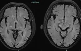 Người đàn ông mắc viêm não tự miễn thể hiếm gặp