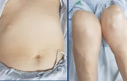 Cảnh báo hội chứng Cushing do lạm dụng thuốc corticoid