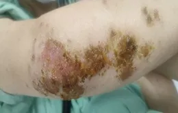Thay đổi thói quen để kiểm soát bệnh viêm da cơ địa