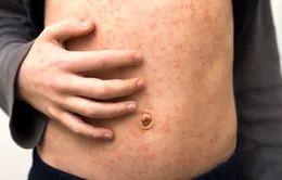 Hơn một nửa thế giới đối mặt với nguy cơ cao mắc bệnh sởi