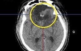 Đi khám vì đau đầu, chóng mặt, người bệnh phát hiện khối u não lớn