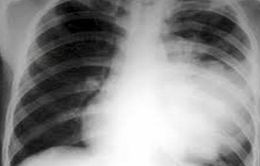Cảnh báo gia tăng viêm phổi do vi khuẩn Mycoplasma ở trẻ nhỏ