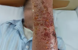 Người đàn ông bị dị ứng thuốc, viêm mô bào từ vết xước nhỏ do mèo cào