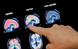 Trí tuệ nhân tạo giúp phát hiện sớm bệnh Alzheimer