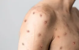 WHO họp khẩn về sự lây lan của bệnh đậu mùa khỉ