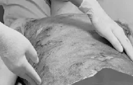 Trượt chân ngã khi bê nồi nước sôi, nam bệnh nhân bị bỏng nặng