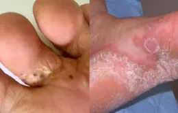 Phòng tránh bệnh về da và nguy cơ bỏng mùa bão lũ