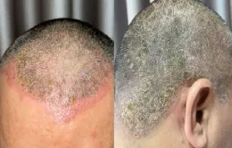 Dị ứng da đầu do thuốc nhuộm tóc