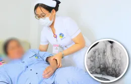 Bỏng cồn khi đi giác hơi