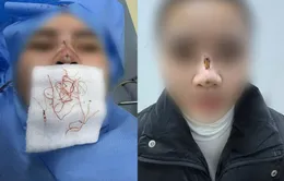 Rủi ro khi căng chỉ nâng mũi: Những biến chứng khó lường