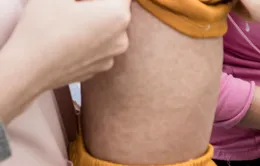Nhiều trẻ mắc sởi do chưa tiêm vaccine