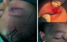 Nghệ An: Cấp cứu trẻ bị chó cắn tổn thương nghiêm trọng vùng mặt