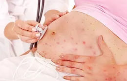 Mẹ bầu mắc sởi - Có ảnh hưởng em bé?