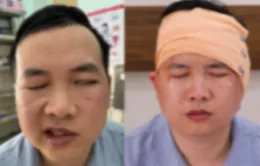 Liệt dây thần kinh số VII ngoại biên sau bị ngã