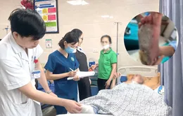 Bỏng độ III, nhiễm trùng gan bàn chân vì chườm nóng