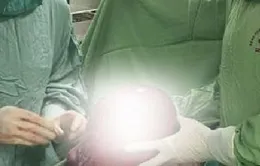 Ngỡ béo bụng, nhập viện phát hiện khối u xơ kích thước 21cm