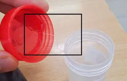 Gắp ký sinh trùng dài gần... 10cm trong mắt người phụ nữ