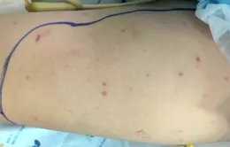 Đồng Nai ghi nhận trường hợp mắc não mô cầu, chưa tiêm vaccine phòng bệnh