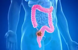 Phát hiện yếu tố làm tăng nguy cơ ung thư đại tràng ở người trẻ
