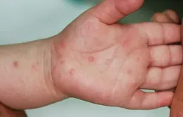 TP Hồ Chí Minh: Ca mắc tay chân miệng tăng 30%