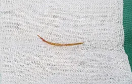 Liên tiếp 3 ca thủng nội tạng do xương cá, bác sĩ cảnh báo nguy cơ tử vong